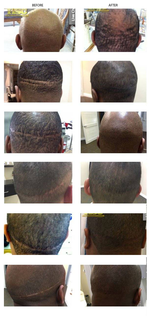 SMP for Hair Transplant Scars – Permanent Makeup of Atlanta: Medical SMP