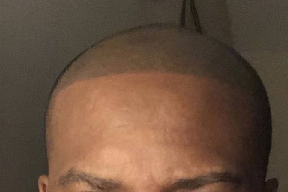 Man's scalp after scalp micropigmentation